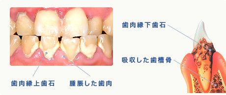歯周病は歯周病原菌の感染によって発症します。